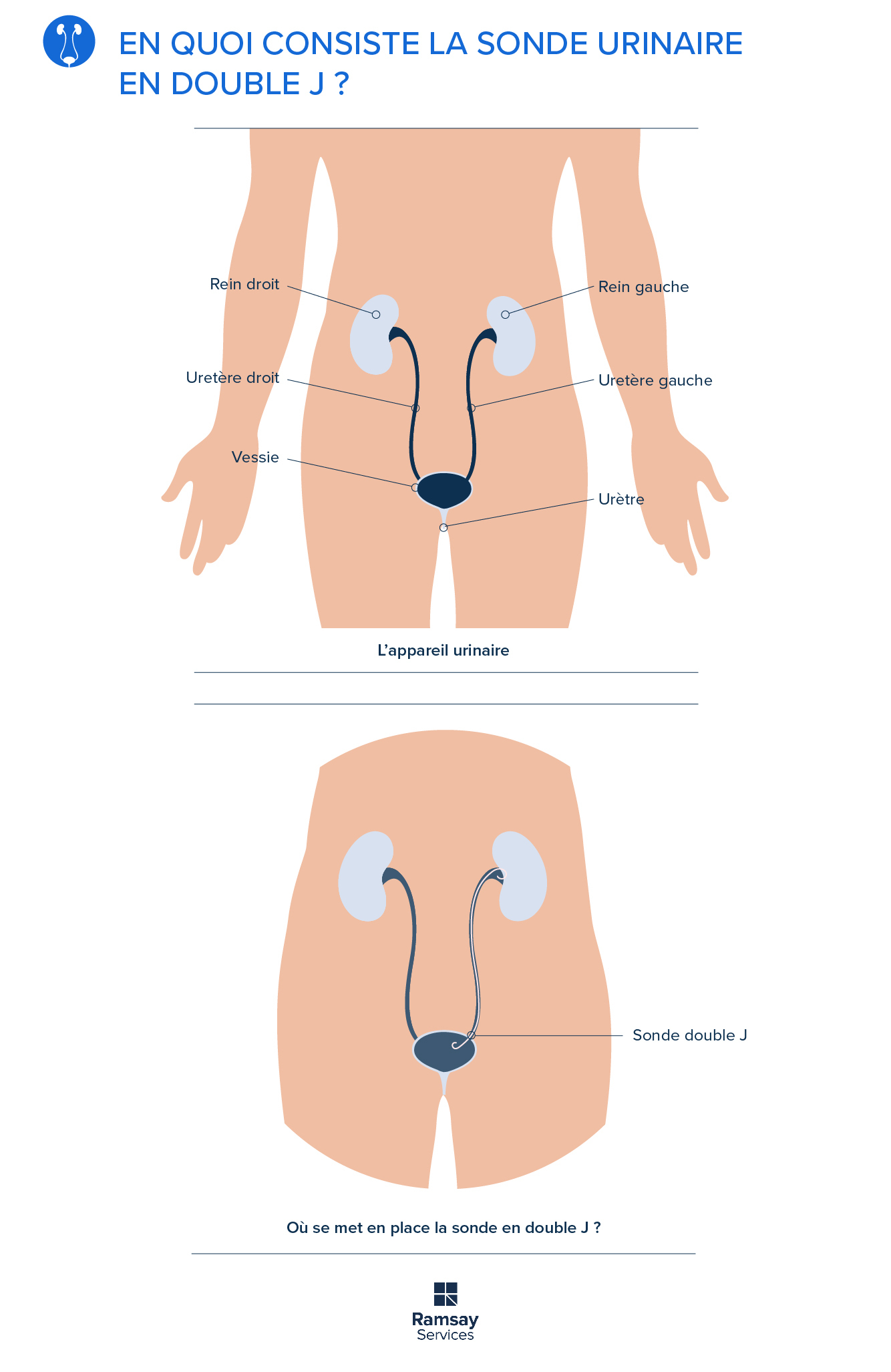 Urologie En Quoi Consiste La Sonde Urinaire En Double J