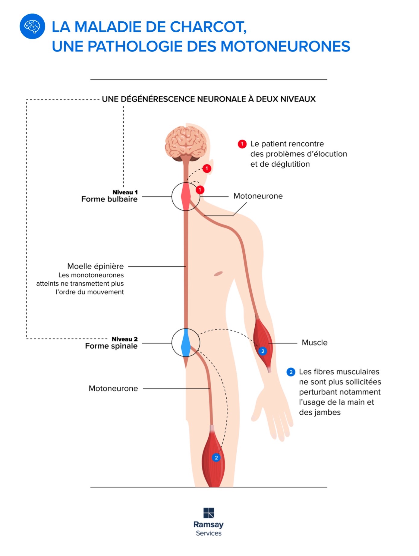 charcot