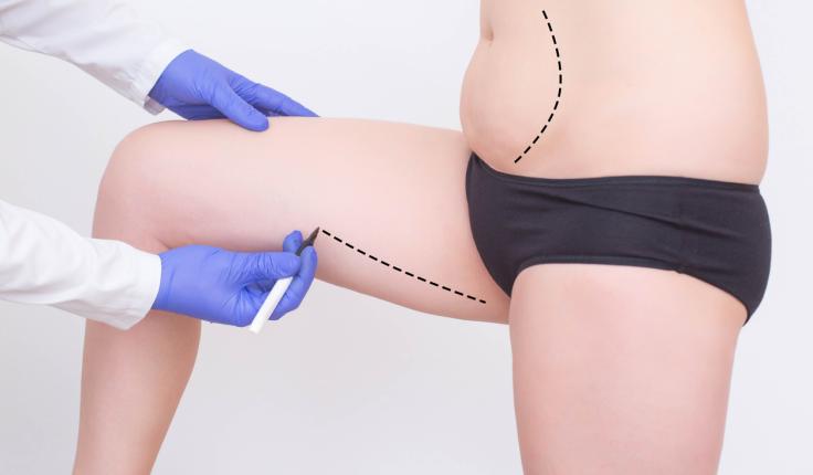 Lipofilling : comment fonctionne cette technique de chirurgie esthétique ?