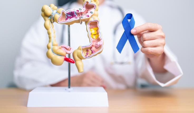 cancer colorectal