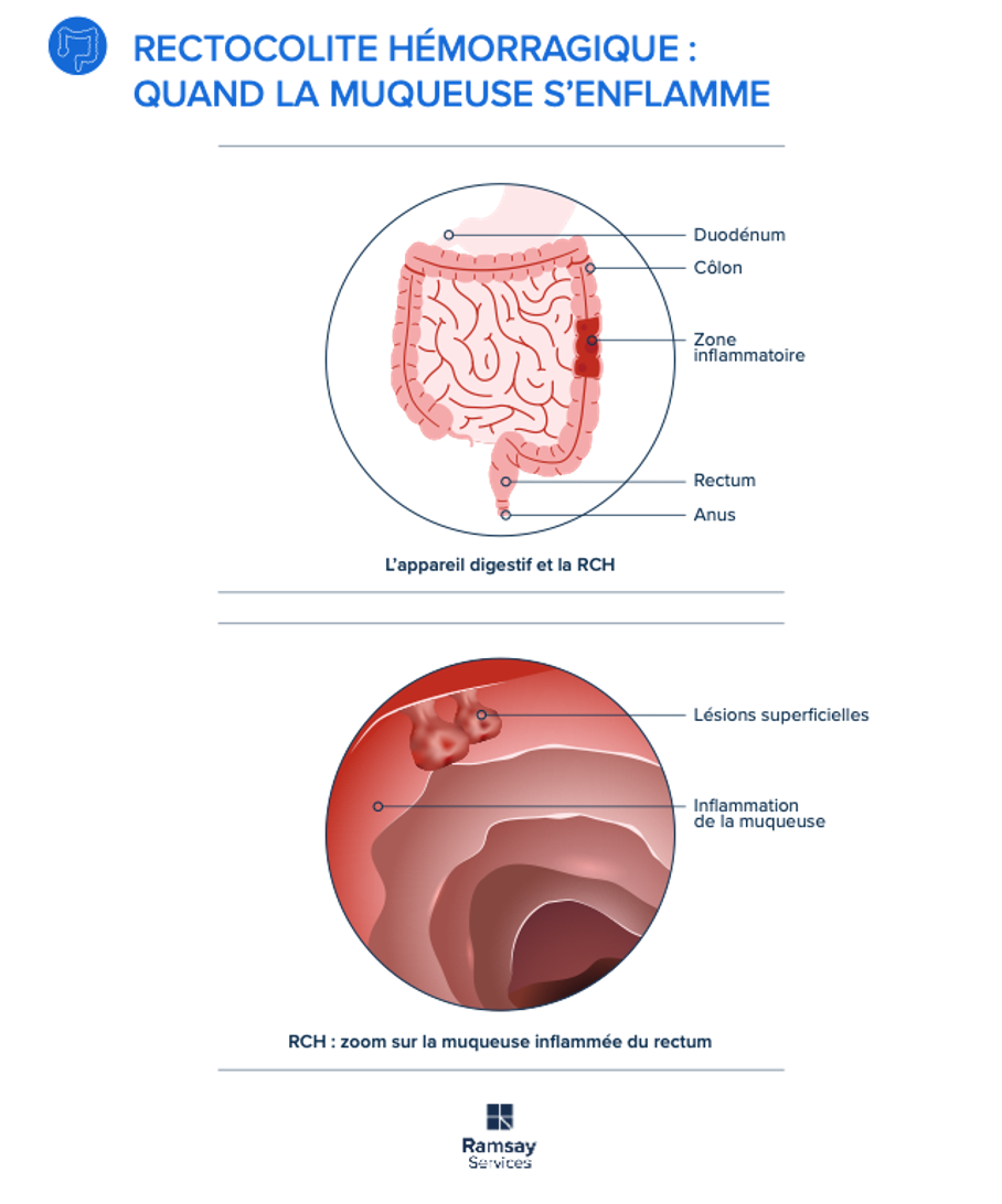 infog-rectocolite