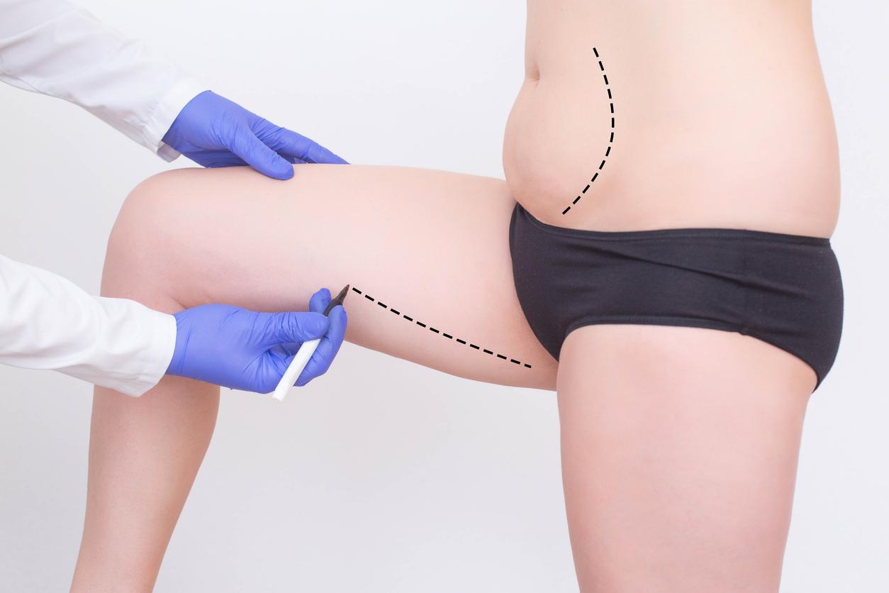 Lipofilling : comment fonctionne cette technique de chirurgie esthétique ?